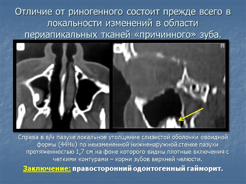 Отличие от риногенного состоит прежде всего в локальности изменений в области периапикальных тканей «причинного»